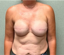 Breast Reconstruction After Photo by Michael Yang, MD; Bettendorf, IA - Case 50875
