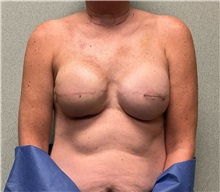 Breast Reconstruction Before Photo by Michael Yang, MD; Bettendorf, IA - Case 50875