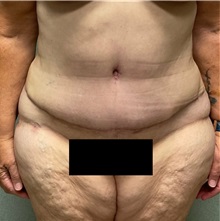 Tummy Tuck After Photo by Michael Yang, MD; Bettendorf, IA - Case 50880