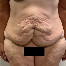 Tummy Tuck Before Photo by Michael Yang, MD; Bettendorf, IA - Case 50880