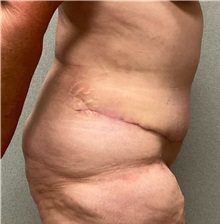 Tummy Tuck After Photo by Michael Yang, MD; Bettendorf, IA - Case 50880