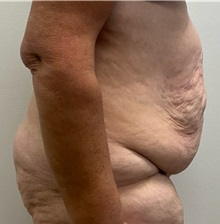 Tummy Tuck Before Photo by Michael Yang, MD; Bettendorf, IA - Case 50880