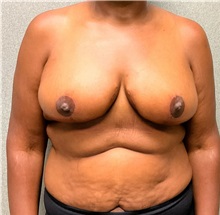 Breast Reduction After Photo by Michael Yang, MD; Bettendorf, IA - Case 50879