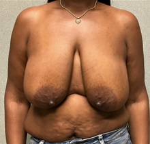 Breast Reduction Before Photo by Michael Yang, MD; Bettendorf, IA - Case 50879