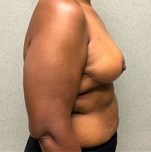 Breast Reduction After Photo by Michael Yang, MD; Bettendorf, IA - Case 50879