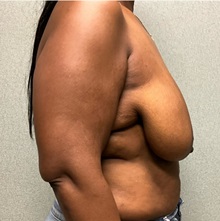 Breast Reduction Before Photo by Michael Yang, MD; Bettendorf, IA - Case 50879