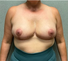 Breast Reduction After Photo by Michael Yang, MD; Bettendorf, IA - Case 50882