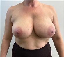 Breast Reduction Before Photo by Michael Yang, MD; Bettendorf, IA - Case 50882