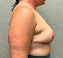 Breast Reduction After Photo by Michael Yang, MD; Bettendorf, IA - Case 50882