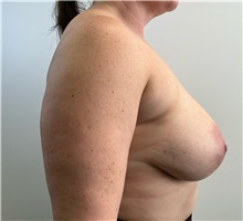 Breast Reduction Before Photo by Michael Yang, MD; Bettendorf, IA - Case 50882