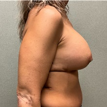 Breast Augmentation After Photo by Michael Yang, MD; Bettendorf, IA - Case 50883