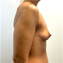 Breast Augmentation Before Photo by Michael Yang, MD; Bettendorf, IA - Case 50883