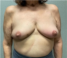 Breast Reduction After Photo by Michael Yang, MD; Bettendorf, IA - Case 50885