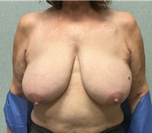 Breast Reduction Before Photo by Michael Yang, MD; Bettendorf, IA - Case 50885
