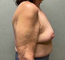 Breast Reduction After Photo by Michael Yang, MD; Bettendorf, IA - Case 50885