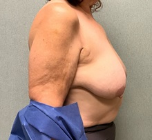 Breast Reduction Before Photo by Michael Yang, MD; Bettendorf, IA - Case 50885