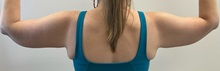 Arm Lift After Photo by Michael Yang, MD; Bettendorf, IA - Case 50888