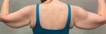 Arm Lift Before Photo by Michael Yang, MD; Bettendorf, IA - Case 50888