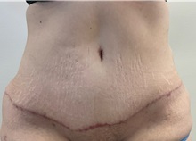 Tummy Tuck After Photo by Michael Yang, MD; Bettendorf, IA - Case 50887