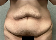 Tummy Tuck Before Photo by Michael Yang, MD; Bettendorf, IA - Case 50887