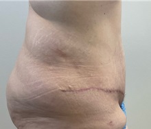Tummy Tuck After Photo by Michael Yang, MD; Bettendorf, IA - Case 50887