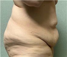 Tummy Tuck Before Photo by Michael Yang, MD; Bettendorf, IA - Case 50887