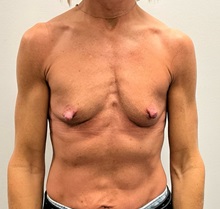 Breast Augmentation Before Photo by Michael Yang, MD; Bettendorf, IA - Case 50891