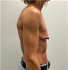 Breast Augmentation Before Photo by Michael Yang, MD; Bettendorf, IA - Case 50891