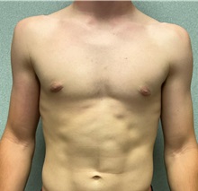 Male Breast Reduction After Photo by Michael Yang, MD; Bettendorf, IA - Case 50898
