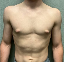 Male Breast Reduction Before Photo by Michael Yang, MD; Bettendorf, IA - Case 50898