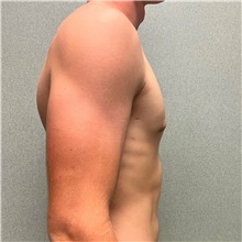 Male Breast Reduction After Photo by Michael Yang, MD; Bettendorf, IA - Case 50898