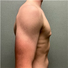 Male Breast Reduction Before Photo by Michael Yang, MD; Bettendorf, IA - Case 50898