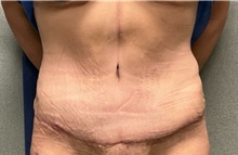 Tummy Tuck After Photo by Michael Yang, MD; Bettendorf, IA - Case 50959