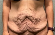 Tummy Tuck Before Photo by Michael Yang, MD; Bettendorf, IA - Case 50959
