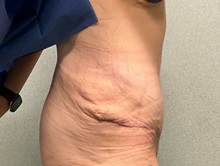 Tummy Tuck After Photo by Michael Yang, MD; Bettendorf, IA - Case 50959