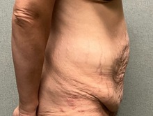 Tummy Tuck Before Photo by Michael Yang, MD; Bettendorf, IA - Case 50959