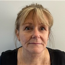 Facelift After Photo by Michael Yang, MD; Bettendorf, IA - Case 50960