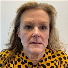 Facelift Before Photo by Michael Yang, MD; Bettendorf, IA - Case 50960