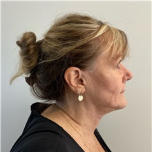 Facelift After Photo by Michael Yang, MD; Bettendorf, IA - Case 50960