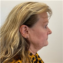 Facelift Before Photo by Michael Yang, MD; Bettendorf, IA - Case 50960