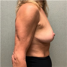 Breast Lift After Photo by Michael Yang, MD; Bettendorf, IA - Case 50958
