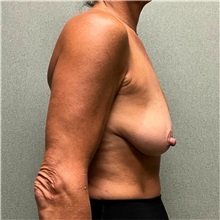 Breast Lift Before Photo by Michael Yang, MD; Bettendorf, IA - Case 50958