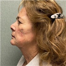 Injectable Fillers and Fat Transfer to the Face After Photo by Michael Yang, MD; Bettendorf, IA - Case 50961