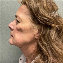 Injectable Fillers and Fat Transfer to the Face Before Photo by Michael Yang, MD; Bettendorf, IA - Case 50961