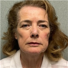 Injectable Fillers and Fat Transfer to the Face After Photo by Michael Yang, MD; Bettendorf, IA - Case 50961