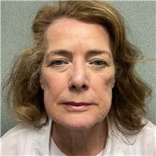 Injectable Fillers and Fat Transfer to the Face Before Photo by Michael Yang, MD; Bettendorf, IA - Case 50961