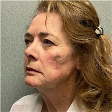 Injectable Fillers and Fat Transfer to the Face After Photo by Michael Yang, MD; Bettendorf, IA - Case 50961
