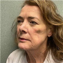 Injectable Fillers and Fat Transfer to the Face Before Photo by Michael Yang, MD; Bettendorf, IA - Case 50961
