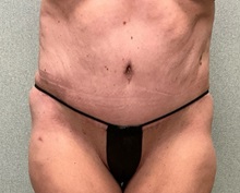 Tummy Tuck After Photo by Michael Yang, MD; Bettendorf, IA - Case 50986