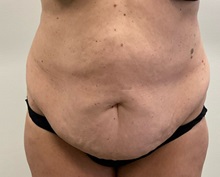 Tummy Tuck Before Photo by Michael Yang, MD; Bettendorf, IA - Case 50986
